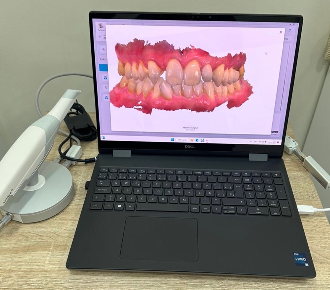 Escáner intraoral vs impresiones físicas dental morante implantes en madrid