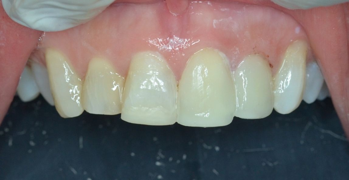 reposicionamiento labial sonrisa gingival dental morante implantes en madrid