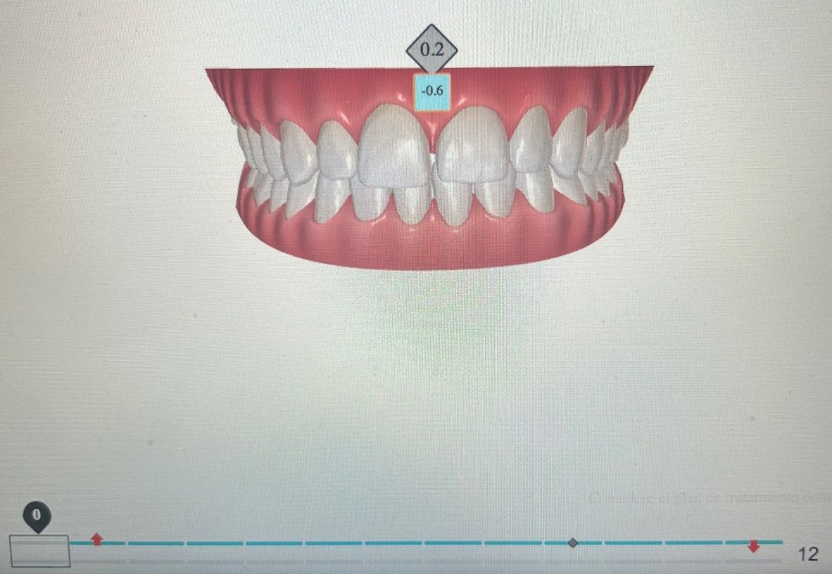 Ortodoncia Invisible Diseño Digital QuickCheck ClinCheck Approver u otros dental morante implantes en madrid