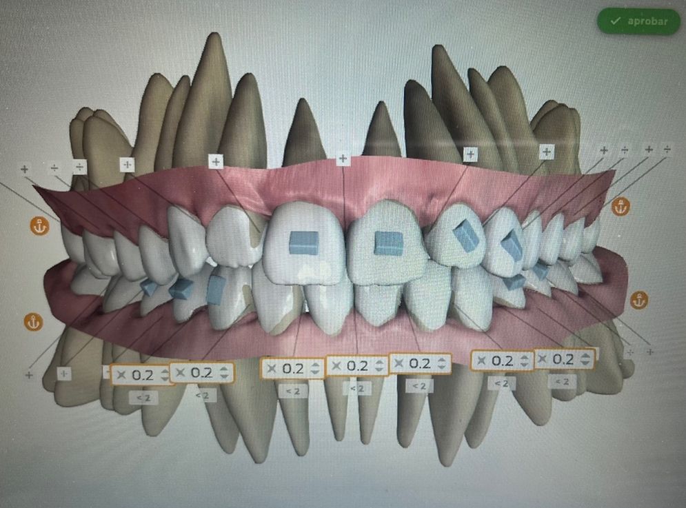 Ortodoncia Invisible Diseño Digital QuickCheck ClinCheck Approver u otros dental morante implantes en madrid