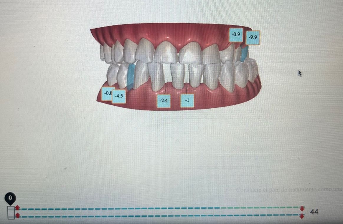 Ortodoncia Invisible Diseño Digital QuickCheck ClinCheck Approver u otros dental morante implantes en madrid