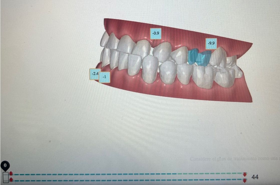 Ortodoncia Invisible Diseño Digital QuickCheck ClinCheck Approver u otros dental morante implantes en madrid