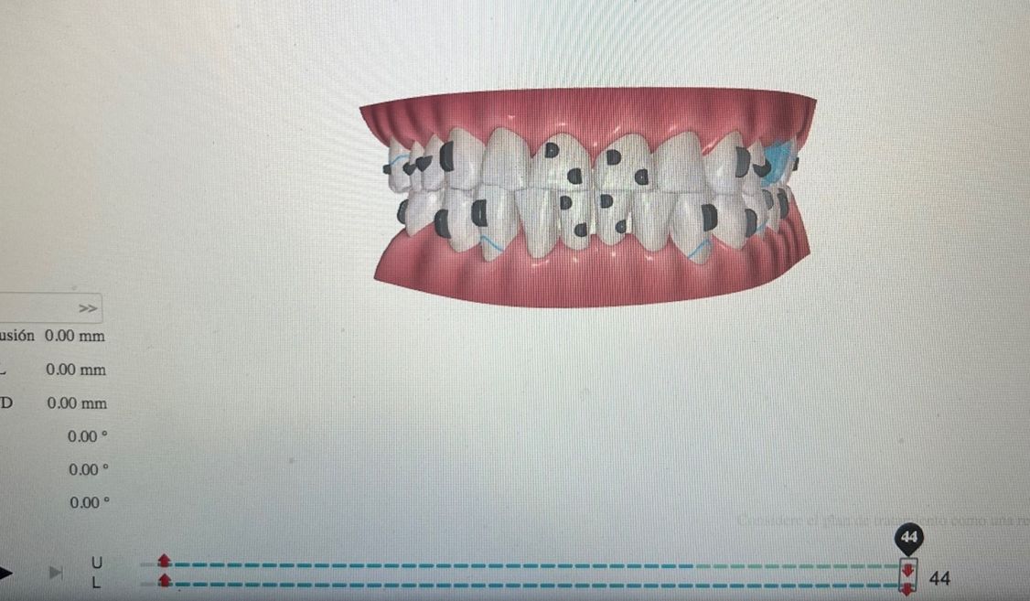 Ortodoncia Invisible Diseño Digital QuickCheck ClinCheck Approver u otros dental morante implantes en madrid