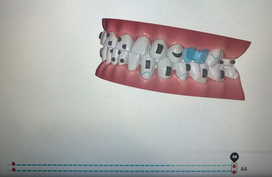 Ortodoncia Invisible Diseño Digital QuickCheck ClinCheck Approver u otros dental morante implantes en madrid