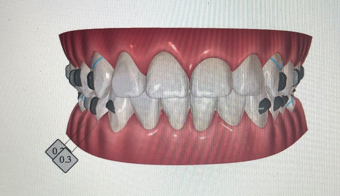 Ortodoncia Invisible Diseño Digital QuickCheck ClinCheck Approver u otros dental morante implantes en madrid