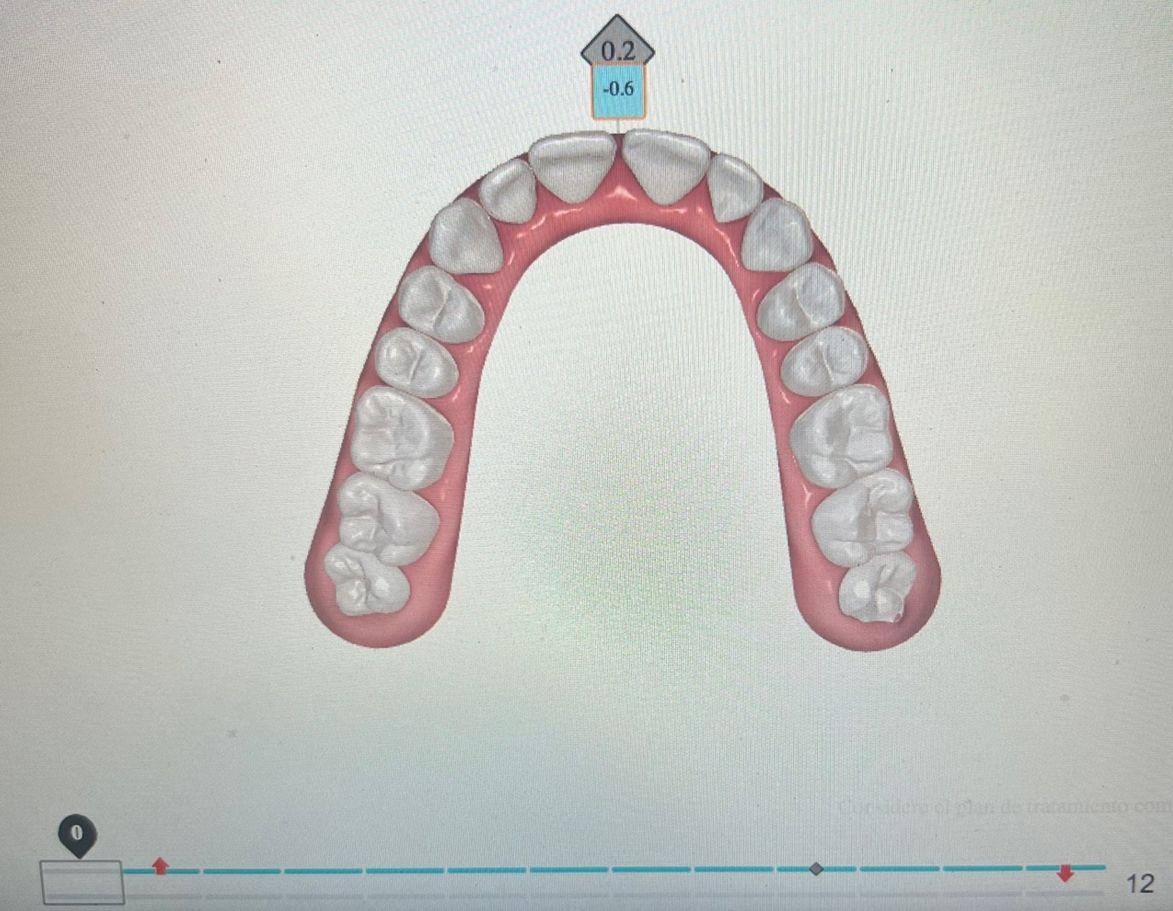 Ortodoncia Invisible Diseño Digital QuickCheck ClinCheck Approver u otros dental morante implantes en madrid