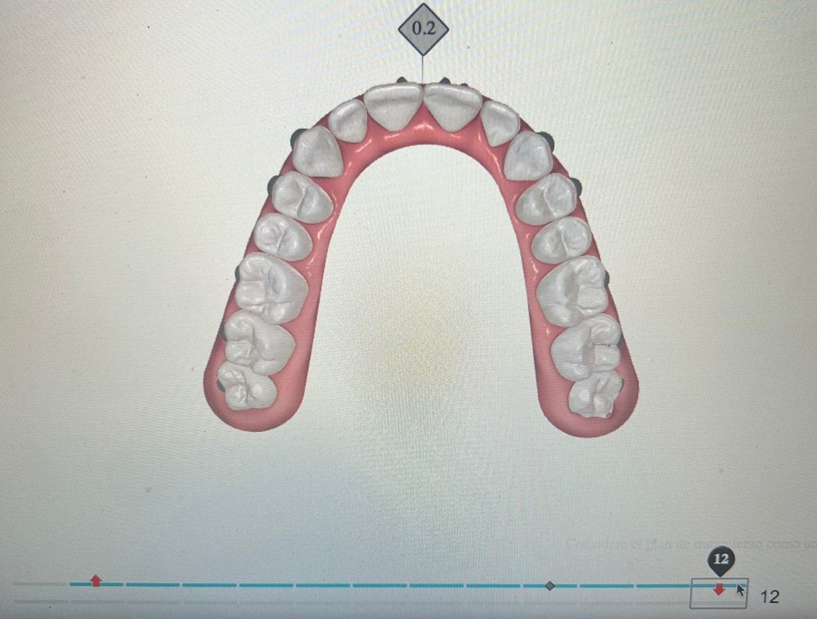 Ortodoncia Invisible Diseño Digital QuickCheck ClinCheck Approver u otros dental morante implantes en madrid