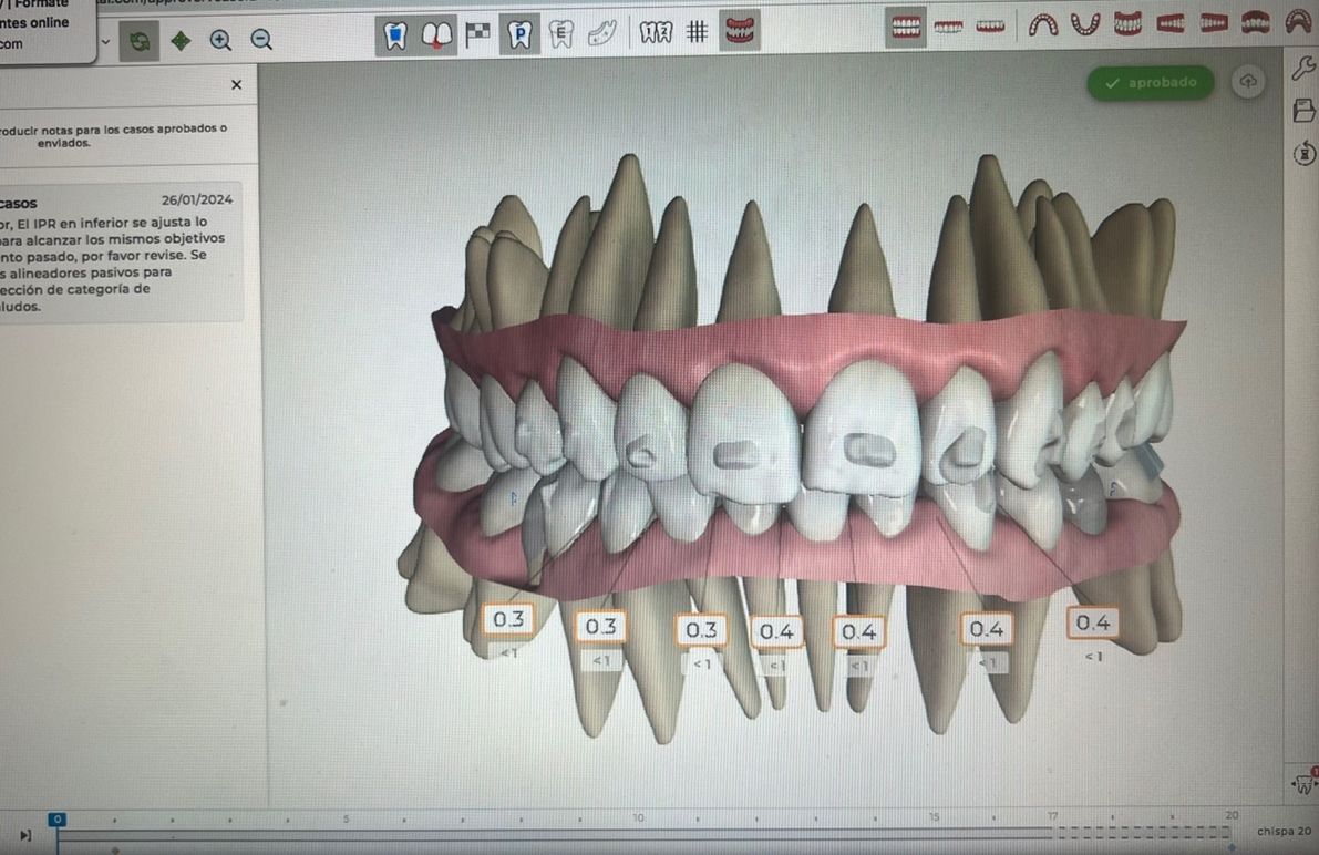 Ortodoncia Invisible Diseño Digital QuickCheck ClinCheck Approver u otros dental morante implantes en madrid