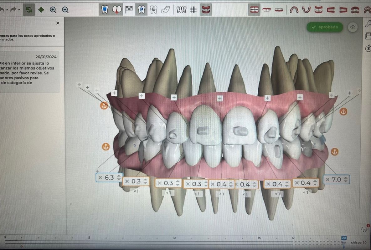 Ortodoncia Invisible Diseño Digital QuickCheck ClinCheck Approver u otros dental morante implantes en madrid