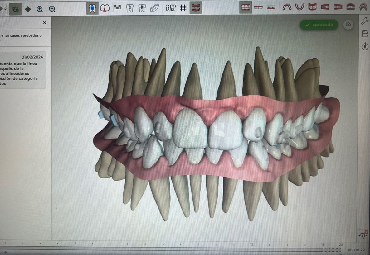 Ortodoncia Invisible Diseño Digital QuickCheck ClinCheck Approver u otros dental morante implantes en madrid