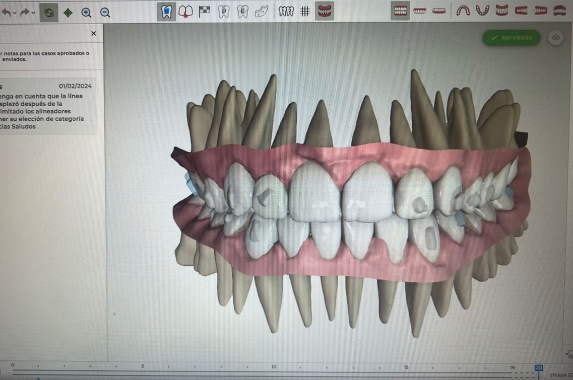 Ortodoncia Invisible Diseño Digital QuickCheck ClinCheck Approver u otros dental morante implantes en madrid