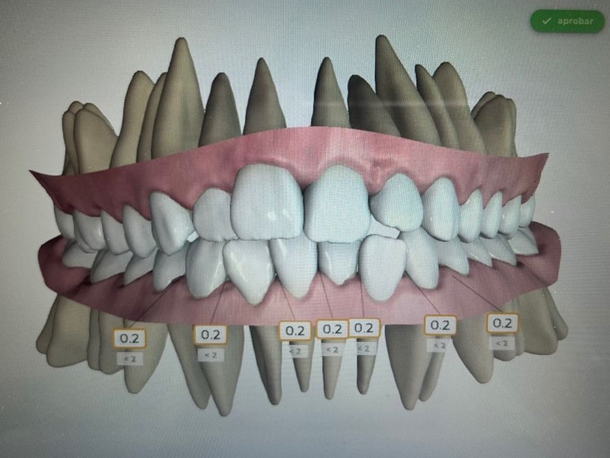 Ortodoncia Invisible Diseño Digital QuickCheck ClinCheck Approver u otros dental morante implantes en madrid