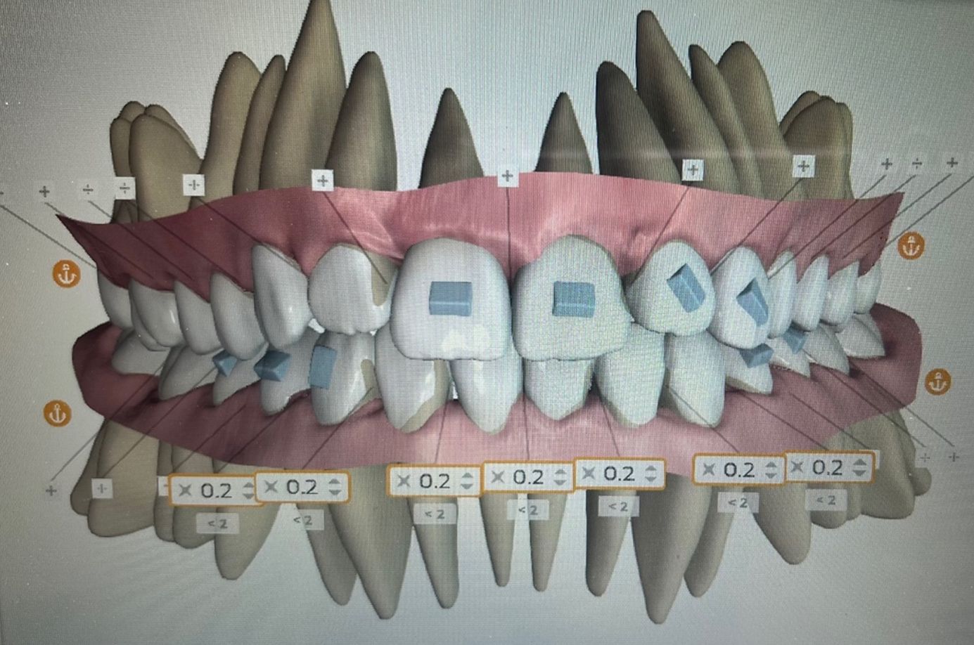 Ortodoncia Invisible. Diseño Digital. QuickCheck/ClinCheck/Approver u otros