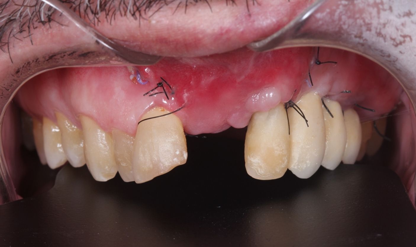 BRUXISMO Te han dicho que aprietas los dientes dental morante implantes en madrid