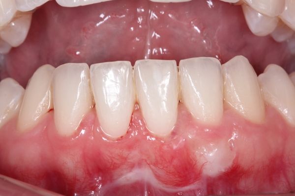 ¿Qué cuidados debemos tener cuando nos hemos sometido a un injerto gingival?