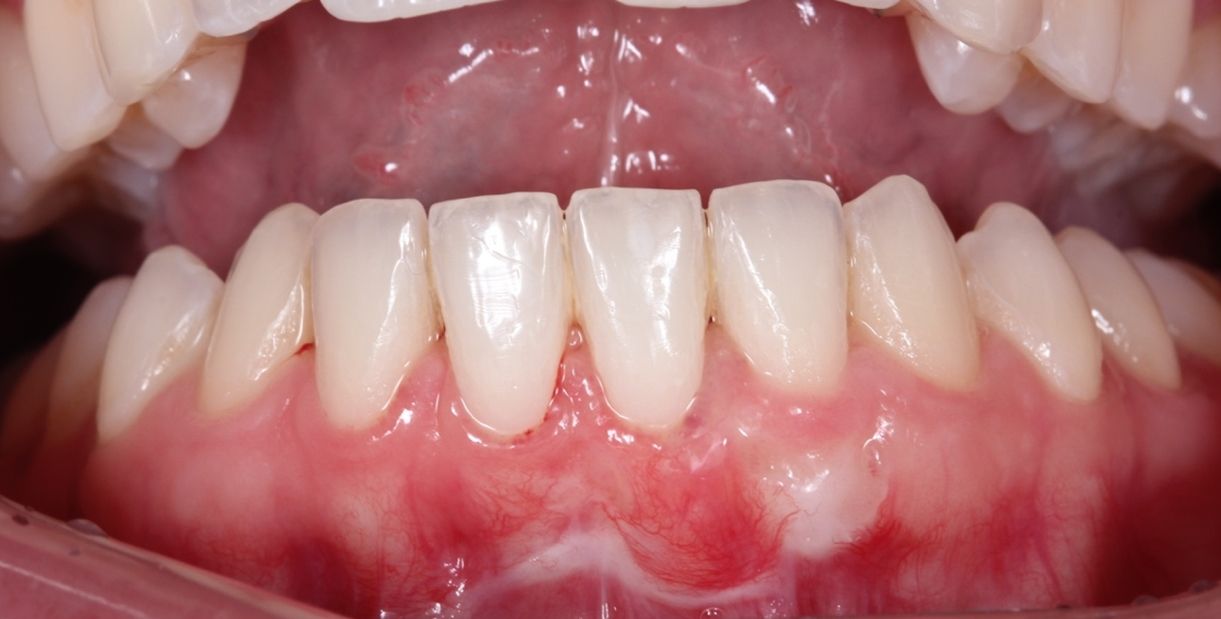 ¿Qué cuidados debemos tener cuando nos hemos sometido a un injerto gingival?