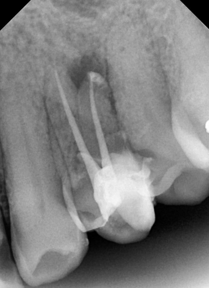 BRUXISMO Te han dicho que aprietas los dientes dental morante implantes en madrid