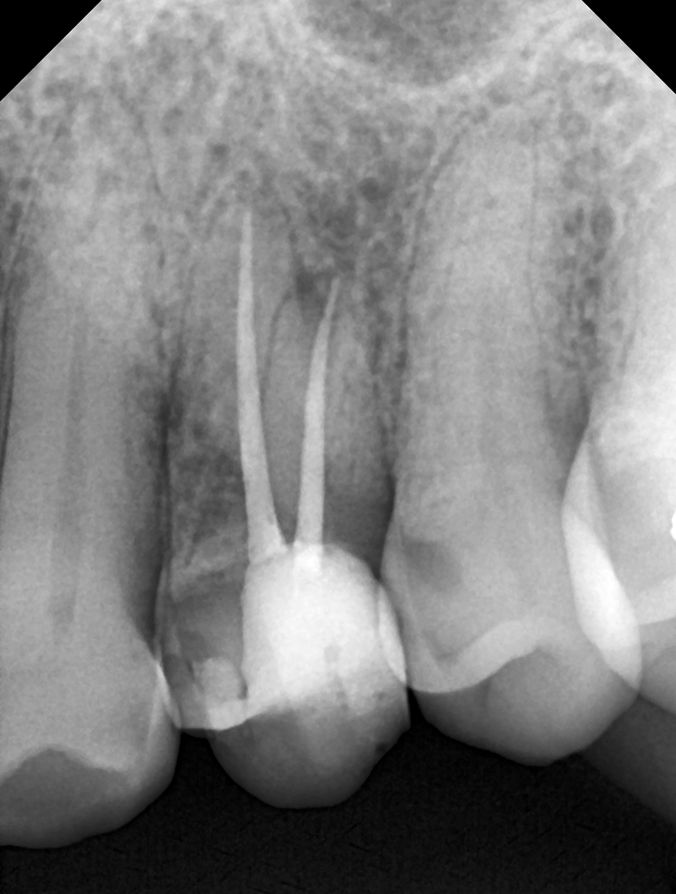 BRUXISMO Te han dicho que aprietas los dientes dental morante implantes en madrid