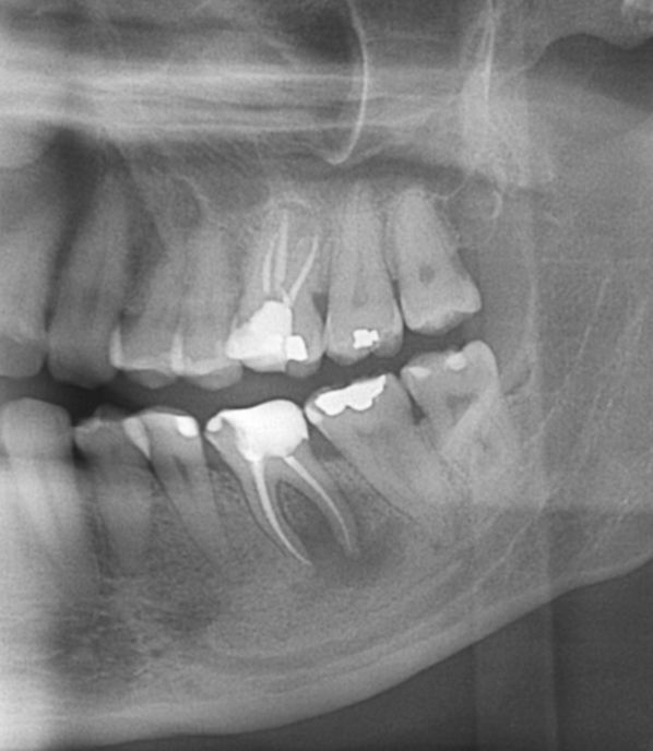 BRUXISMO Te han dicho que aprietas los dientes dental morante implantes en madrid