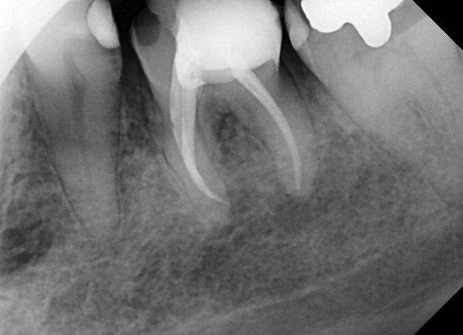 BRUXISMO Te han dicho que aprietas los dientes dental morante implantes en madrid